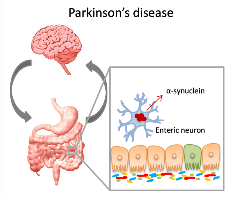 New potential biomarkers for Parkinson’s disease identified in the gut ...